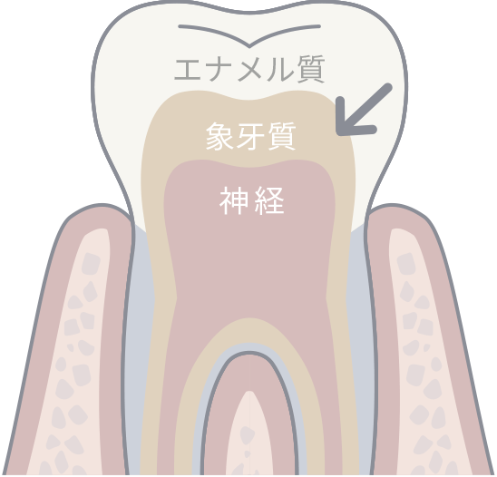 内因性変色